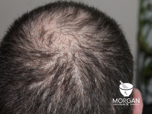 Hair Loss, Compounded Minoxidil and More