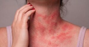 Ketotifen and Cromolyn Sodium in MCAS: Mast Cell Stabilizers and Compounding Options in Georgia