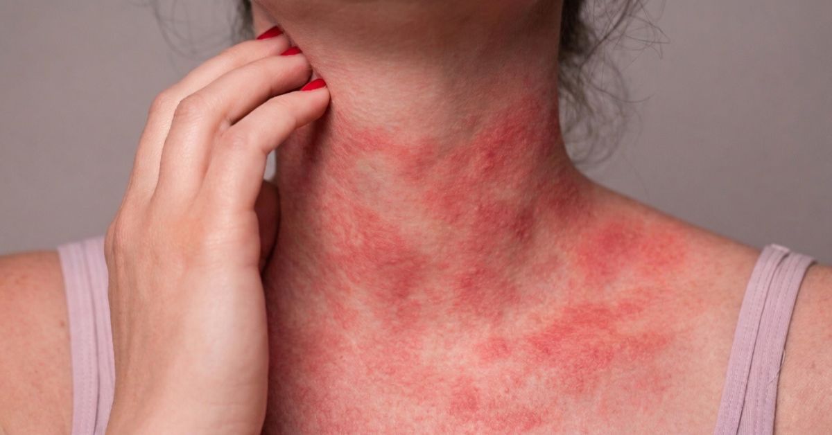 Ketotifen and Cromolyn Sodium in MCAS: Mast Cell Stabilizers and Compounding Options in Georgia