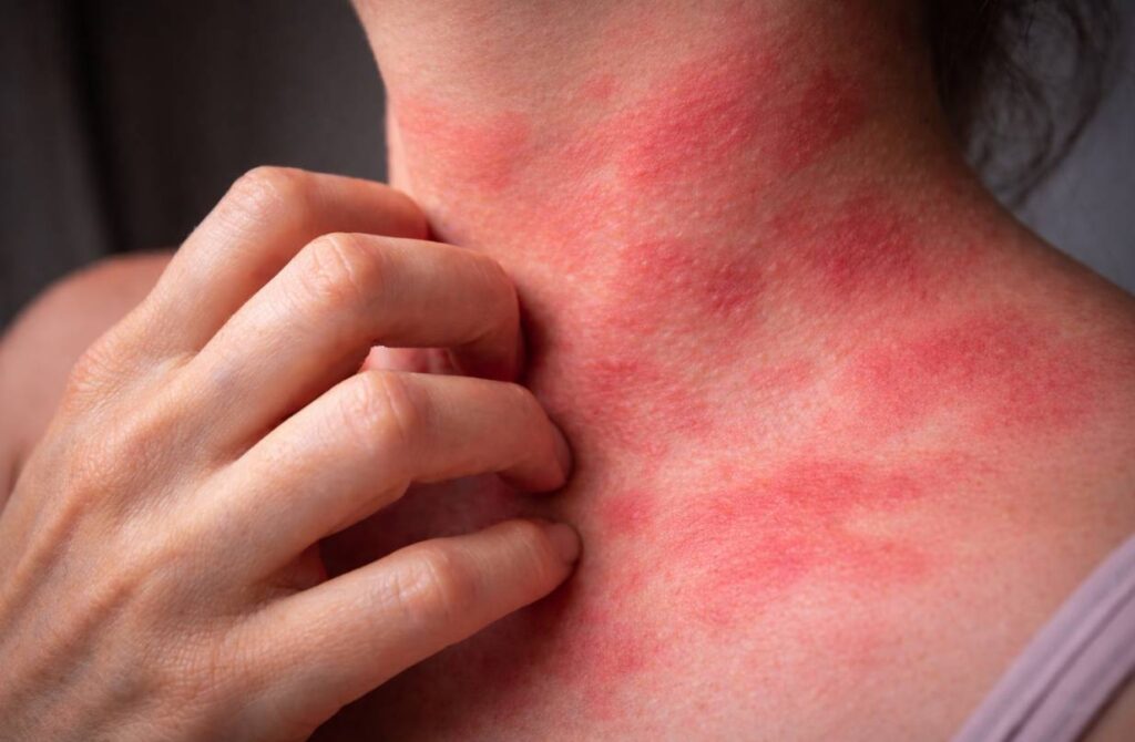 Ketotifen and Cromolyn Sodium in MCAS: Mast Cell Stabilizers and Compounding Options in Georgia