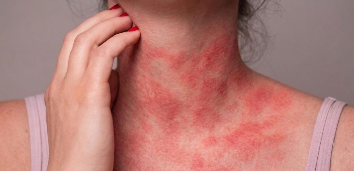 Ketotifen and Cromolyn Sodium in MCAS: Mast Cell Stabilizers and Compounding Options in Georgia